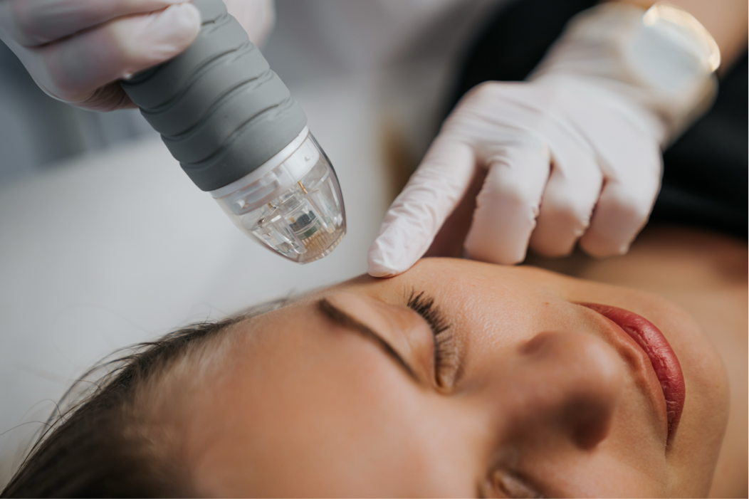 Benefits of Exosome Microneedling